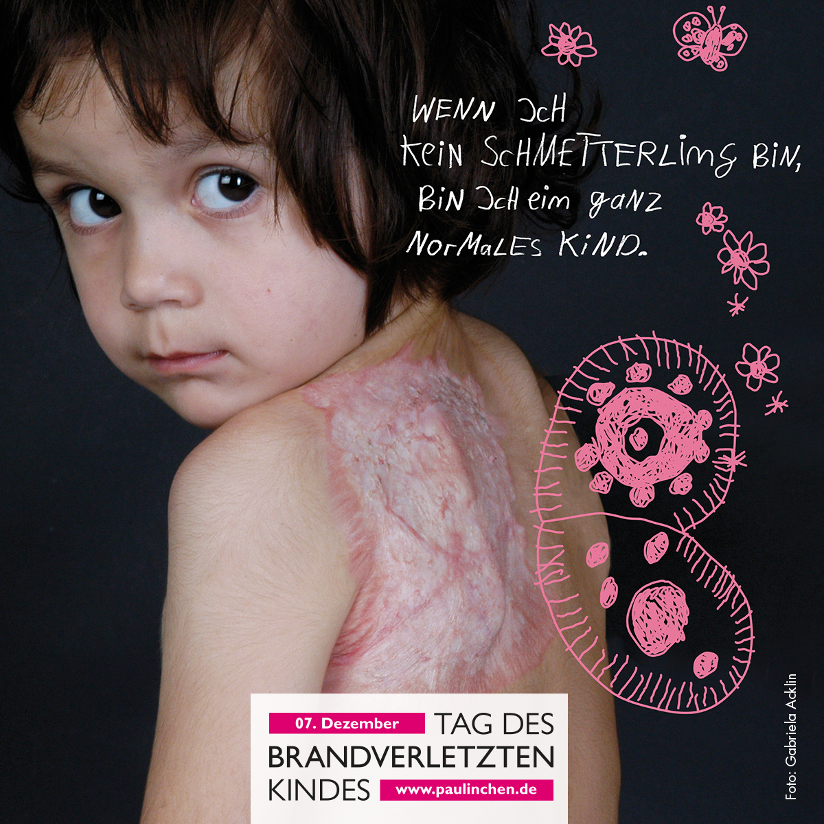 Explodierende Feuerwerkskörper zählen zu den häufigsten Ursachen für schwere Verbrennungen bei Kindern und Jugendlichen rund um Silvester.